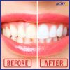 Teeth Whitening + Scaling